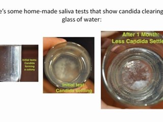 Candida Albicans, the Leading Cause of Cancer