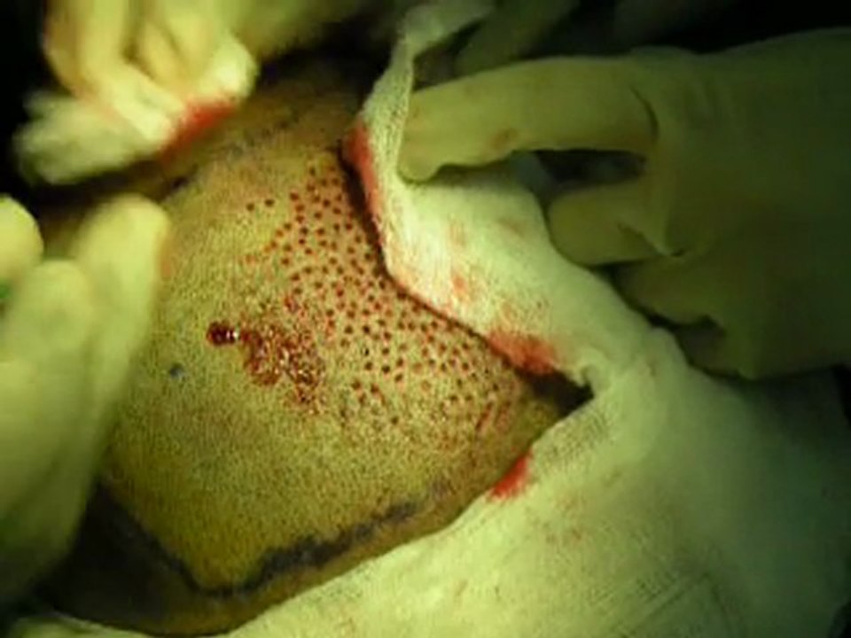 Follicle unit Extraction FUE hair transplant in Lahore