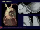 Scanner cardiaque : les enjeux (partie 1)
