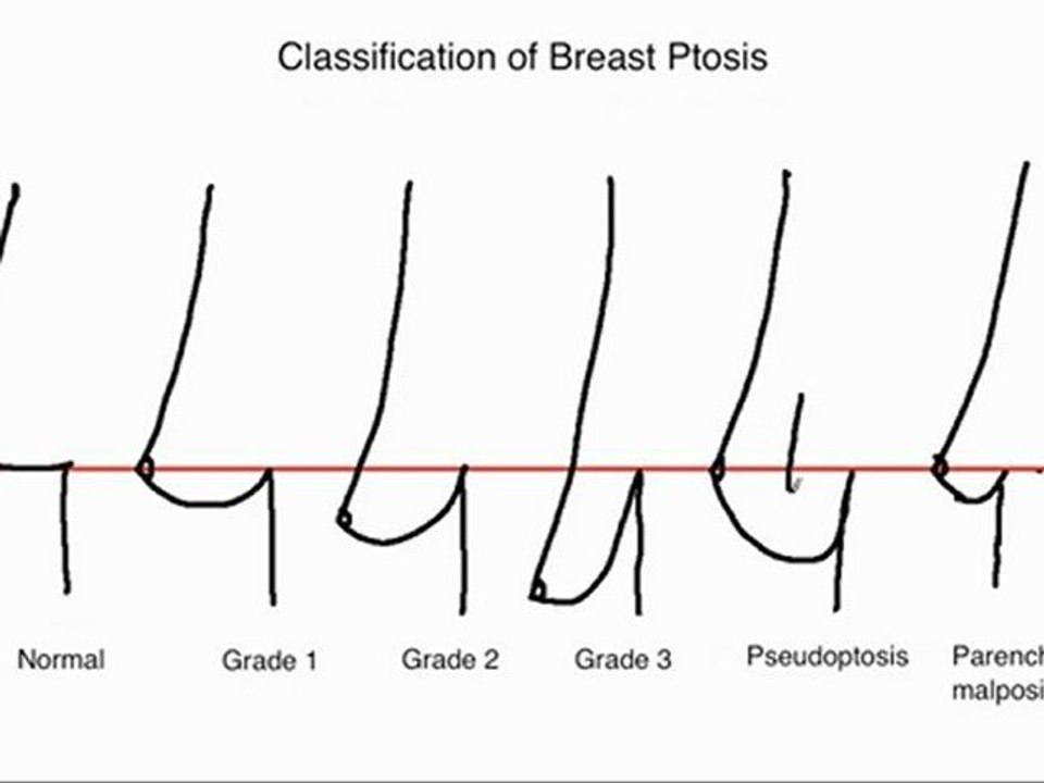 The Classification of Breast Ptosis or Breast Droop
