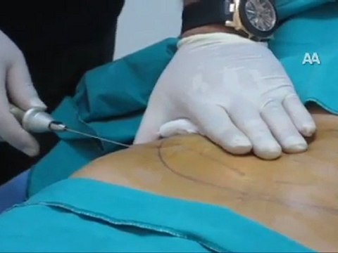 IŞIK TOPU İLE GÖBEKLİ OLMAYA SON