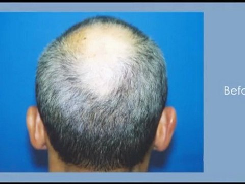 Hair Transplant Before After - Dr Hasson - 5488 Grafts
