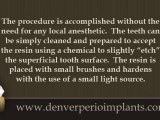 Denver Dental Implant dr. on sealants