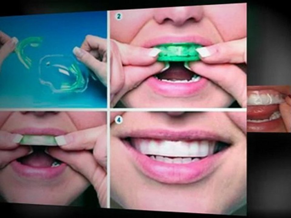 Treswhite - Professional Teeth Whitening
