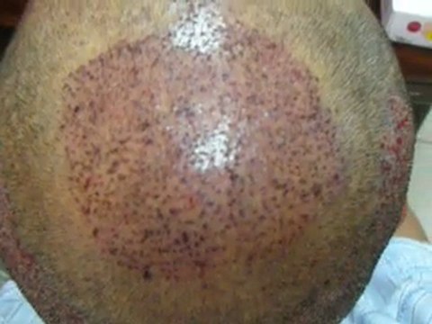Follicle Unit Extraction 2400 grafts in Lahore Pakistan