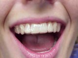 Invisalign Saskatoon Dentist - Invisalign Saskatoon