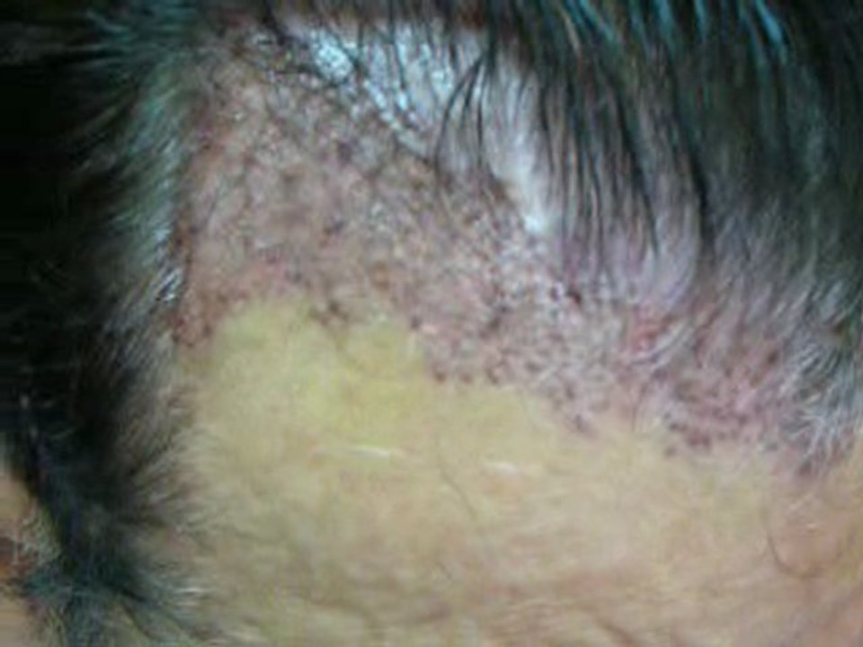 FUE hair transplant  in Pakistan 1113 grafts  day 1