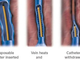 Behandlung Von Hämorrhoiden Bonn Elisées Klinink Bonn - ...