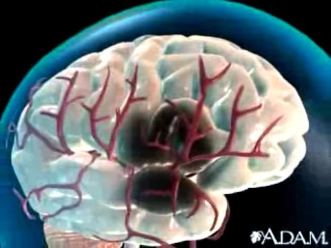 Ictus: Accidente cerebrovascular (ACV)
