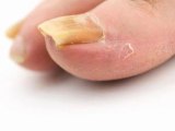 Yellow Toenails- How to Cure Nail Fungus