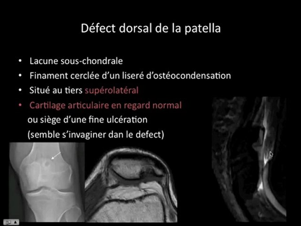 Patella : 3 cas