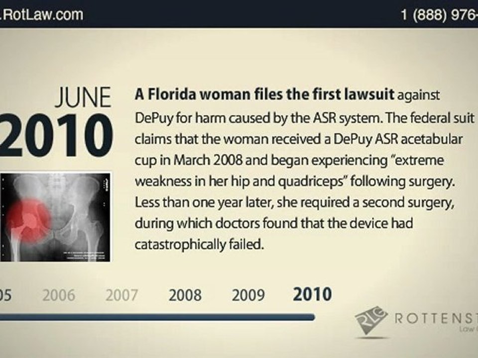 DePuy ASR Hip Recall