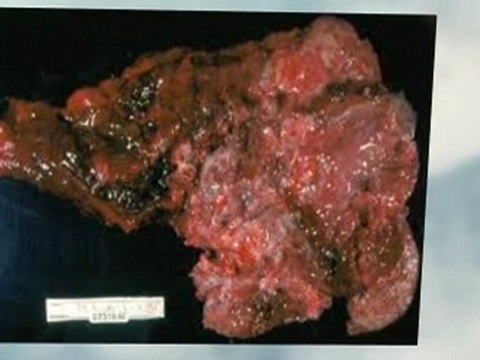 Asbestos Abatement Weslaco