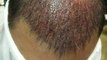 FUE hair Transplantation 1937 grafts in Pakistan/single session by Dr.Ahmad Chaudhry