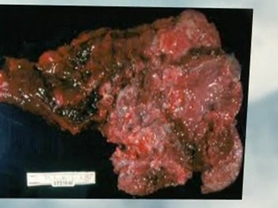 Asbestos Abatement Compton