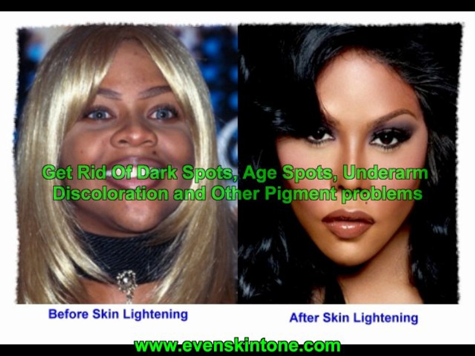 Skin Lightening
