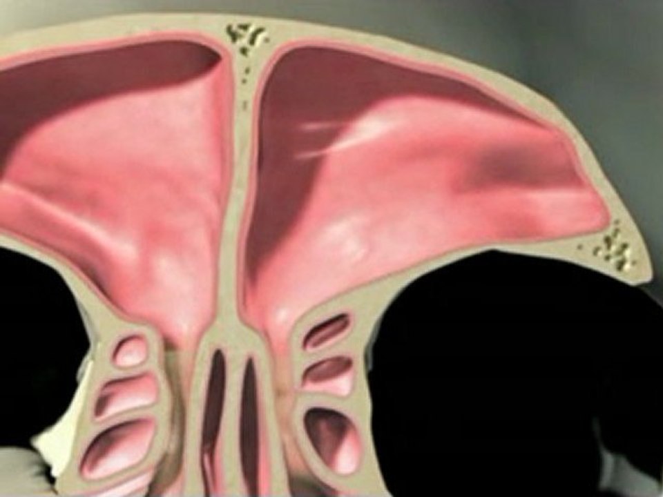 Balloon Sinuplasty technology explanation
