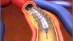 Percutaneous coronary Intervention stenting