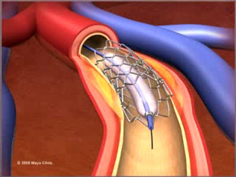 Percutaneous coronary Intervention stenting