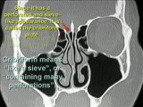 How To Read CT Sinus Scans Like An Expert