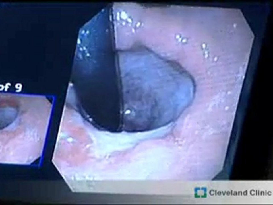 Barretts Esophagus