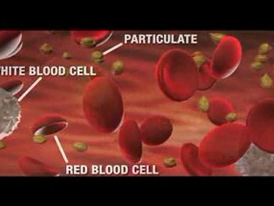 Diamondback 360 - Peripheral Artery Disease PVD PAD