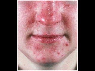 Rosacea Treatments - What Works & What Doesn't