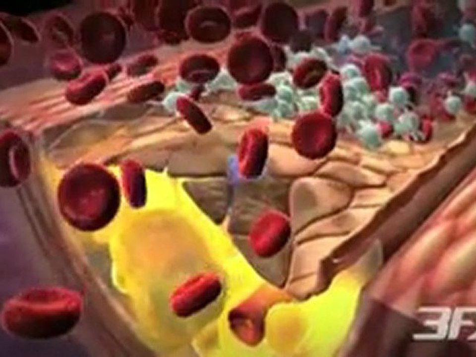 Diabetes-Related Heart Disease