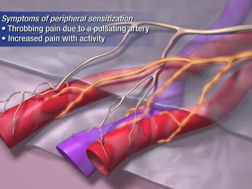 Migraine Pathophysiology