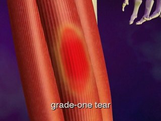 What is a Pulled Hamstring? | Chiropractor Atlanta | Gainesville Ga