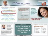 Find a Braces for dental braces