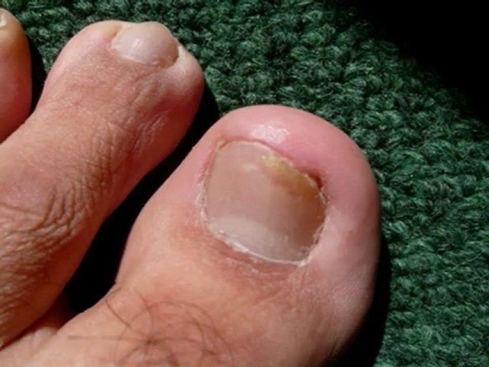 How to Remove Toenail Fungus-Fungi Cure-Toenail Fungus Removal Liquid [www.keepvid.com]