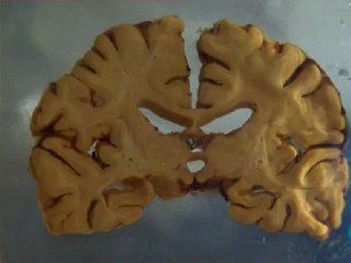 Insomnio Letal Familiar: Lugaresi & Gambetti