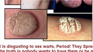 skin tag removal at home - how to remove skin tags - how to get rid of skin tags
