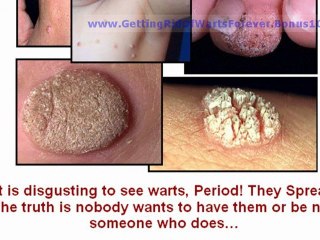 skin tag removal at home - how to remove skin tags - how to get rid of skin tags