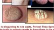 treatment of warts - home remedies for warts - how to remove skin tags yourself