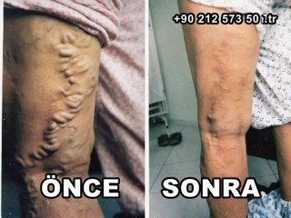 Köpükle Varis Tedavisi İle Sağlığınıza Kavuşun