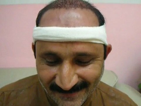 Hair Transplant | Hair Transplant in Pakistan | Hair Transplant Lahore Testimonial