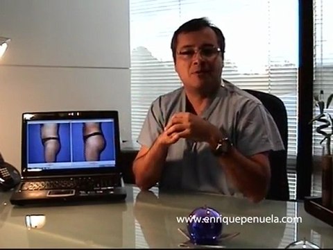 enriquepenuela.com - Gluteoplastia - Cirugia de Gluteos - Dr. Jorge Enrique Peñuela - Parte 2