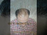 pakistan hair transplant,hair transplant in pakistan,FUE in pakistan