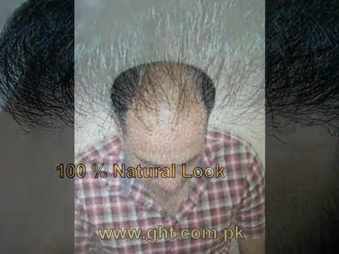 pakistan hair transplant,hair transplant in pakistan,FUE in pakistan