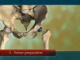 Total hip replacement surgery (video animation)