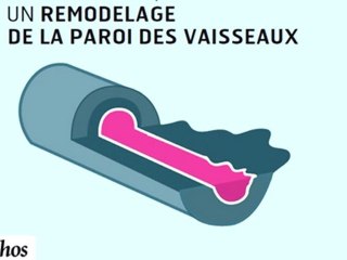Infographie : L'hypertension artérielle pulmonaire