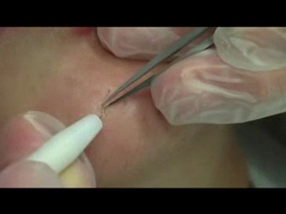 video-permanente-haarentfernung