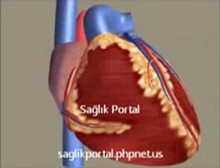 Enfarktüs, Kalp Krizi Animasyonu