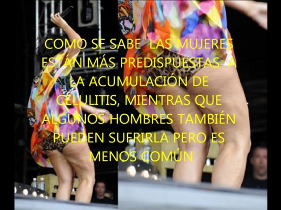 La celulitis que es y que la causa, tratamiento y como combatir la celulitis