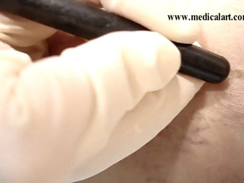 Varis Radyo Frekans ve Kılcal Varis Tedavisi varisistanbul.com