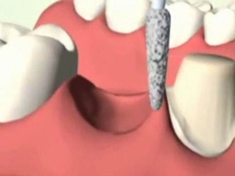 Dental Implant Information - Options for replacing one missing Tooth