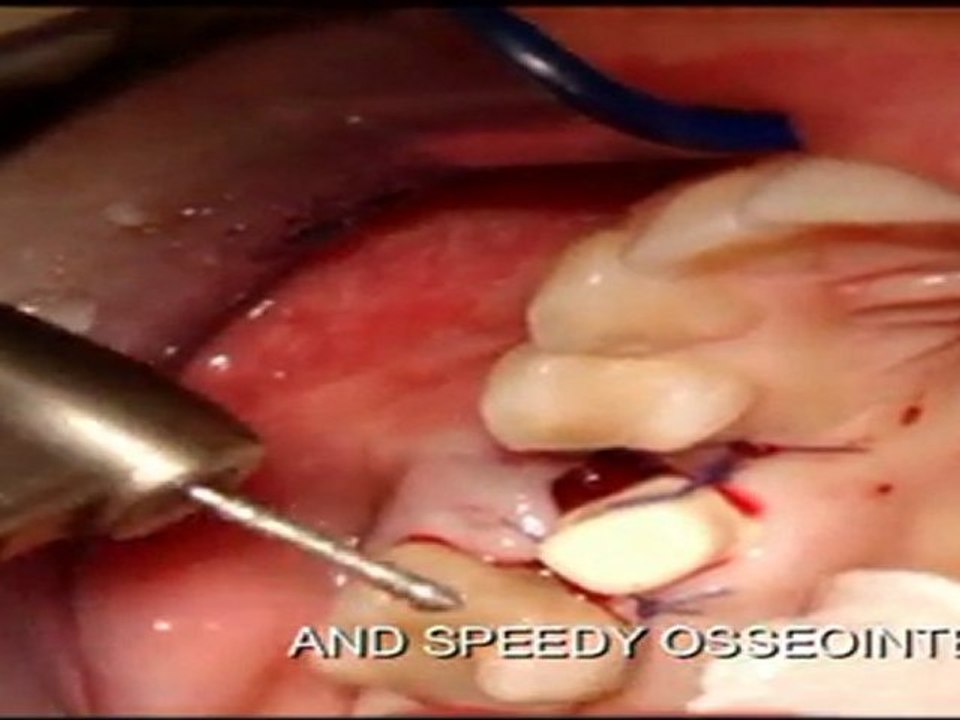 WORLD`S BEST IMMEDIATE ZIRCONIA DENTAL IMPLANT SOLUTION