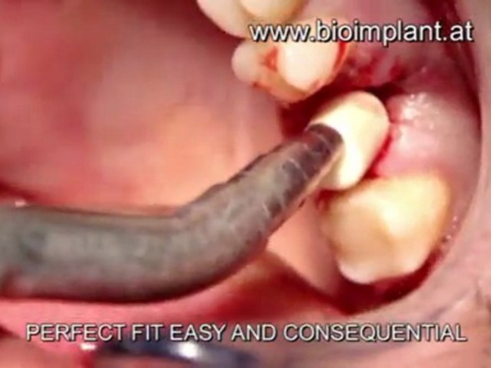 EXPERTS ARE CLUELESS ABOUT IMMEDIATE ANATOMIC ZIRCONIA  UPPER MOLAR IMPLANT METHOD,